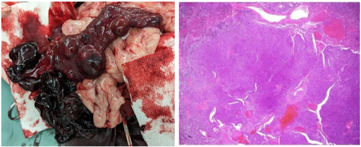 脾臓血管肉腫_英語版Fig